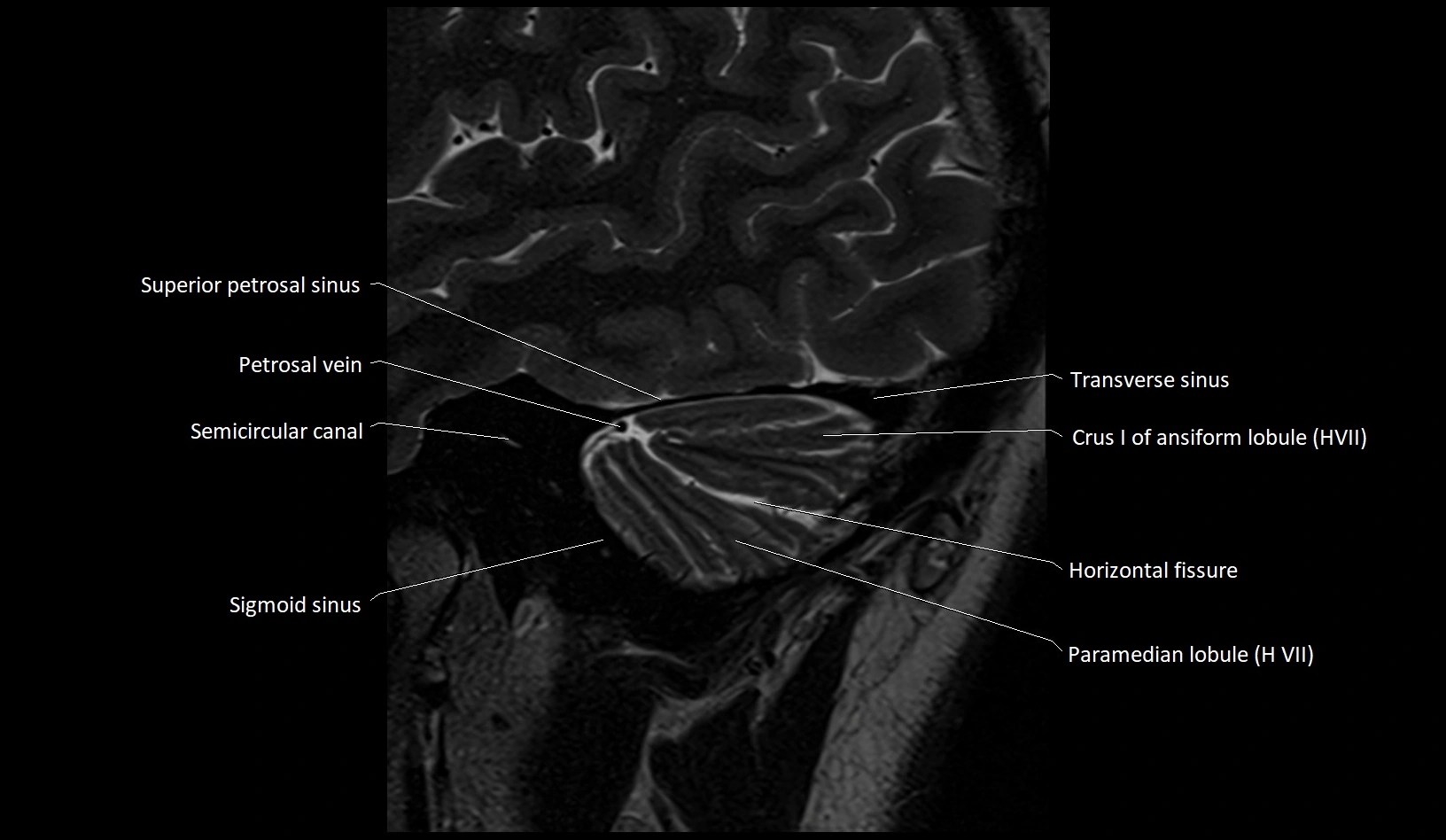 MRI Cerebellar anatomy sagittal High-resolution labelled image 6.webp